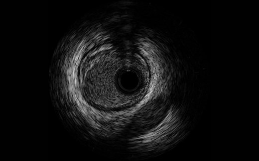 血管内超声系统IVUS-临床示例