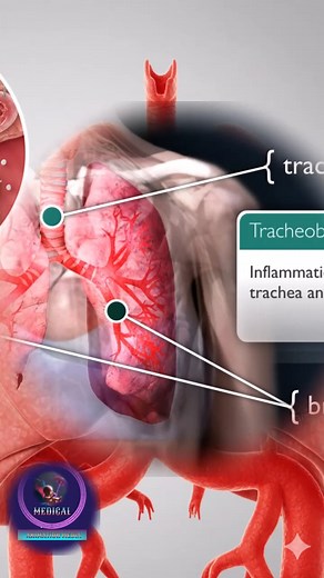 Tracheobronchitis: How Viral Infection Causes Airway Inflammation. #fblifestyle #Tracheobronchitis #AirwayInflammation #ViralInfection #RespiratoryHealth #MedicalAnimation #LungHealth #Trachea #Bronchi #RespiratorySystem #HealthEducation | Medical Animation Media