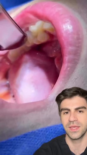 How many extra teeth do you see? #dentist #teeth #tooth #supernumerary #supernumerarytooth