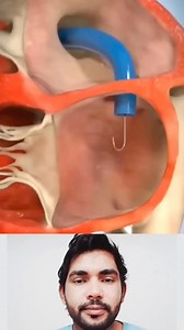 800K views · 2.5K reactions | Altavalve: Transcatheter Mitral Valve Replacement (TMVR) #shorts #medical #animation | Md Imran | Facebook