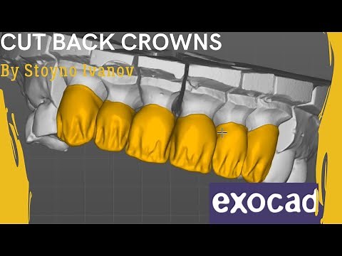 Fastest Exocad Video Tutorial - How To Design Cutback Crowns (For Layering)