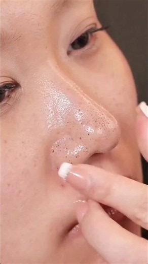Blackhead whitehead Removal At home