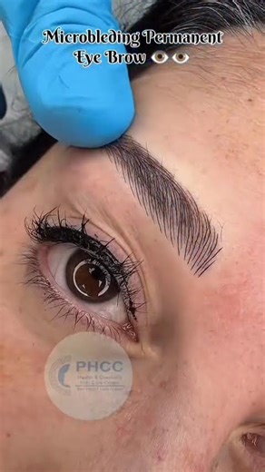 Microbleding bleeding treatment #new #reels #video #explore