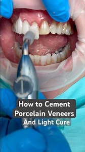 How to Cement Porcelain Veneers ...Step by Step 💕