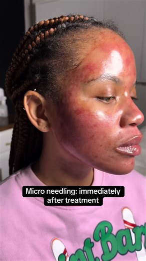 Micro Needling Process and Recovery Timeline Explained