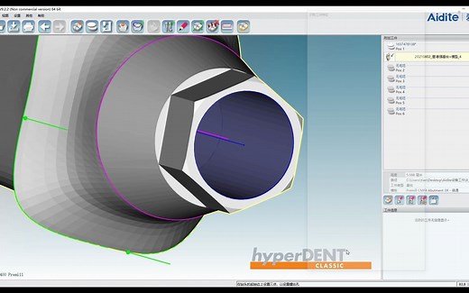 《Aidite之大神再再再次降临！》牙齿设计的精髓在此！Hyperdent软件---钛柱排版特征信息绘制指导视频