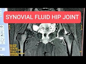 Synovial Fluid Analysis - Synovitis of Hip Joints - MRI Pelvis with both hip joints.