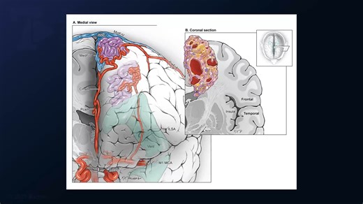 #473: Microsurgical Resection of a Paramedian Frontal Arteriovenous Malformation - All Videos - Seven Series Collection