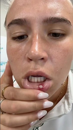 How to Get Rid of Canker Sore😷