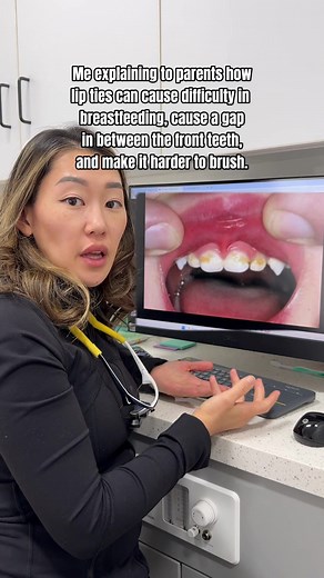 Understanding Lip Tie: What Parents Need to Know