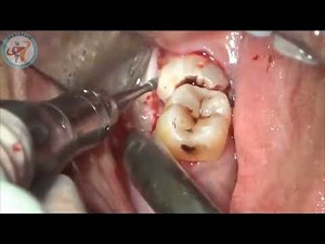How to remove Horizontal Impacted Wisdom Tooth || Step by Step technique