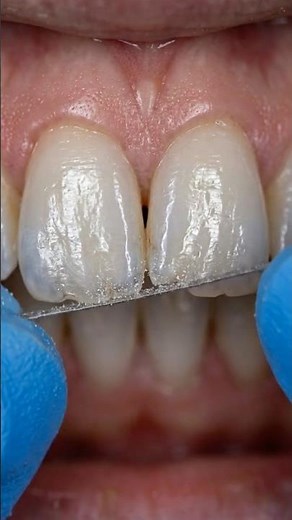 Smoothing Uneven Teeth Edges 🦷 Precision Diamond Finishing