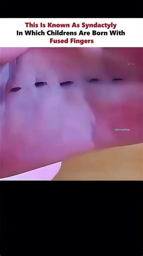 Webed Fingers🤞 #physics #scienceexplained