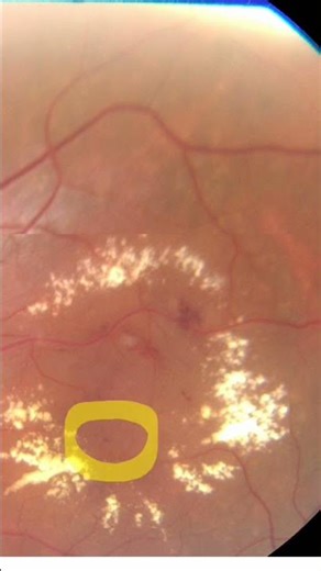 Diabetic macular edema