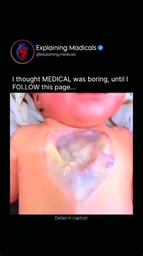 Medical | Health | Anatomy on Instagram: "A Child Born With No Chest Bone (Sternal Agenesis) A child born with no chest bone has a rare congenital condition called sternal agenesis, where the sternum (breastbone) fails to fully form during early fetal development. The sternum normally protects vital organs like the heart and lungs and provides attachment for ribs and chest muscles. When it is partially or completely absent, the heart may be visible or only covered by skin and soft tissue, making