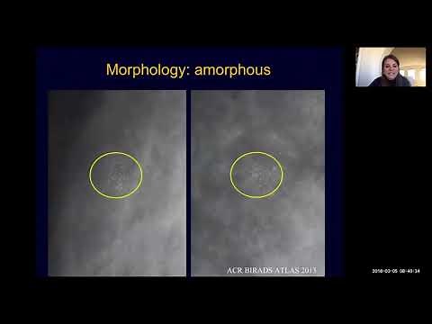 Breast Imaging Calcifications - module 5 | Health4TheWorld Academy