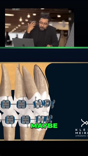 Mastering torque and anchorage: key to faster, better ortho results. Avoid the common pitfalls! #Orthodontics #Dentistry #Braces #Invisalign #OrthoTips