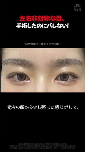 非対称の斜視で二重まぶた手術をしたんだけど、誰も手術したことを知らない！