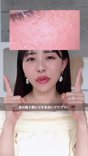 稗粒腫（はいりゅうしゅ）について - 白いプツプツの治療方法