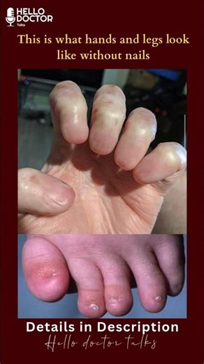 Details in Description 👍 #healthchannel #askdoc #doctor #doctorslife #anonychia #askdoctor