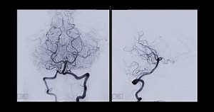 Cerebral angiogram of basilar artery for diagnosis abnormalities such as cerebral artery aneurysms and cerebral artery disease such as atherosclerosis (plaque).