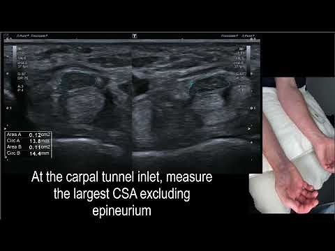 Median Nerve WFR Carpal Tunnel Ultrasound Hobson-Webb
