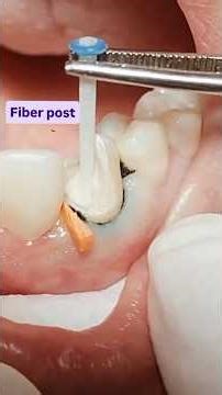Post and Core: Composite restoration after Root Canal Treatment#shorts#dentist#teeth#dentalcaries