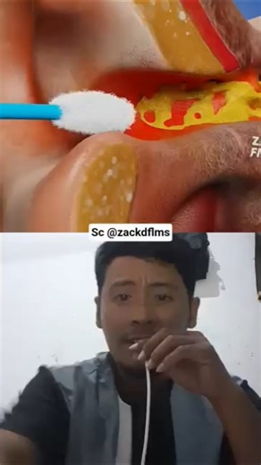 Cotton Swab Stuck in Ear for 1,000 Years! 😱 | Funny Reaction #dentist #comedy