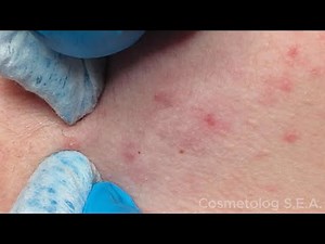 Skin cleansing and comedones extraction. Part 5. (lower face 1)