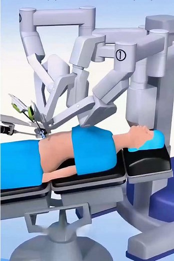 How Gallbladder Removal Surgery is Performed? (3D Animation) #gallbladdersurgery #surgery #stitch #3danimation