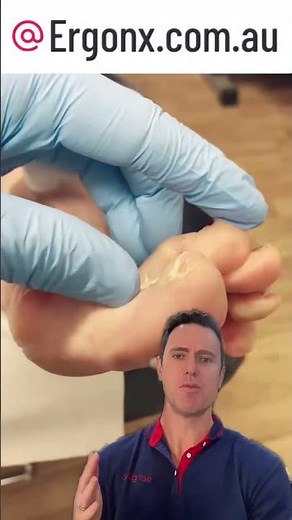 Say Goodbye to Painful Callus & Corn Between Toes Expert Tips & Solutions #FootCare #HealthyFeet