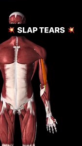 5.8K views · 144 reactions | > SLAP LESIONS/TEARS What is it? Superior labrum, anterior and posterior (to the biceps tendon) tear/lesion 10 different reported types: Type 1 and 2 are reported most frequently Type 1: superior labral fraying with localized degeneration Doctor of physical therapy | Doctor of physical therapy | Facebook