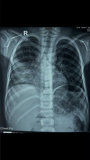 Pneumonia Chest X Ray Findings Explained #shorts