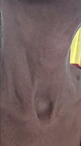 AVNRT | FROG SIGN | Cannon A waves | #cardiology #svt