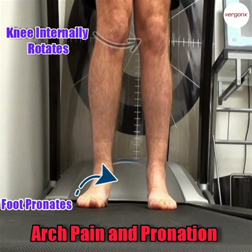 Conquer Arch Pain: Solutions for Overpronation #FootHealth #PainRelief
