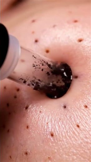 4K Watch this Satisfy Pimple Popping Deep Acne Removal Compilation