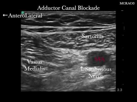 ASA 2016 Ultrasound Guided Adductor Canal Block (blockade) Femoral Nerve Block (blockade)