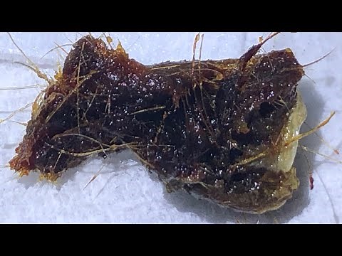 892 - Monumental Ear Wax Removal