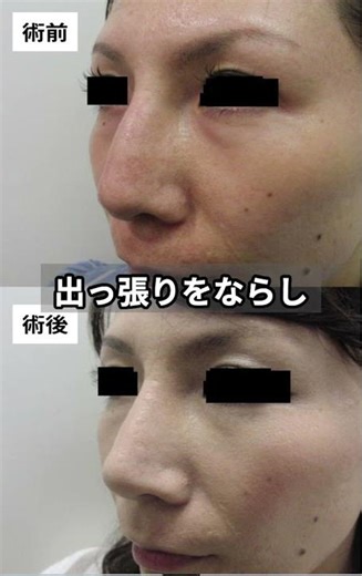 【鼻整形】横顔で損してない？魔女鼻・ハンプを整えて「横顔美人」を作る設計術 #shorts