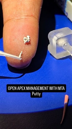 Dr Karan on Instagram: "#dentist Open apex management with mta... Dm on 94681-56879 to know more"