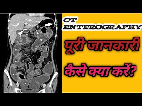 CT ENTEROGRAPGY