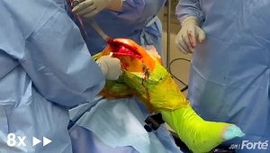 Knee Replacement - Robotic, Kinematic, Tourniquetless, Subvastus