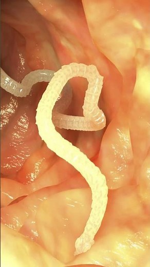 Echinococcosis: The Hidden Parasite! #healthawareness #medicine #publichealth