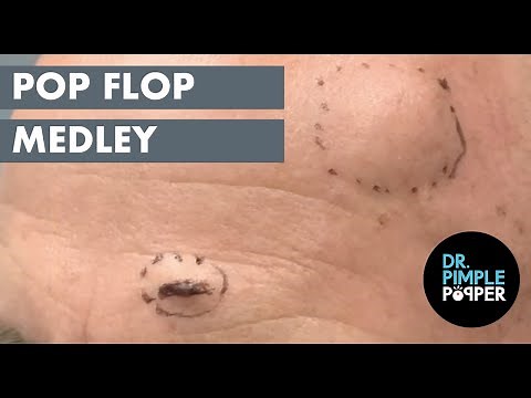 Pop Flop Medley! Steatocystoma and Blackheads