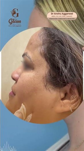 How to Slim Your Jawline & Get a Softer Face Shape | Botox for Masseter