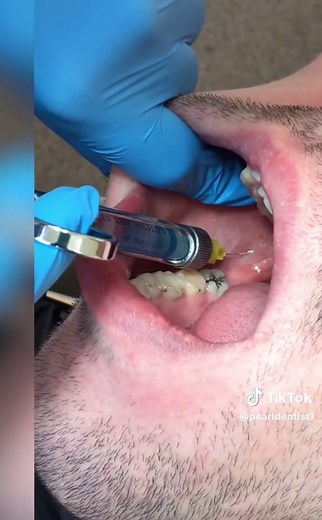 Technique for Mandibular Anaesthesia: Inferior Alveolar Nerve Block