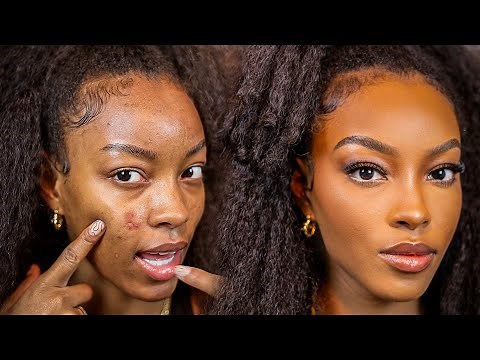 How to Cover Up Acne Blemishes and Active Acne!