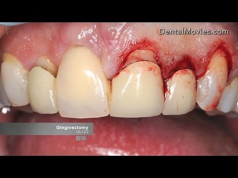 Crown lengthening - Satelec Piezotome 2
