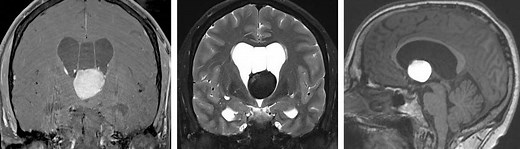 Transcallosal Interforniceal Approach | Cohen Collection | Volumes | The Neurosurgical Atlas