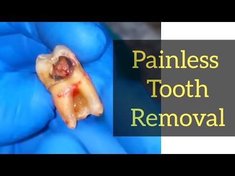 Molar Tooth Extraction Procedure | How a Tooth is Removed Painlessly